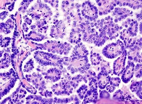CancerRes：新研究发现帮助清除癌症干细胞的新靶标